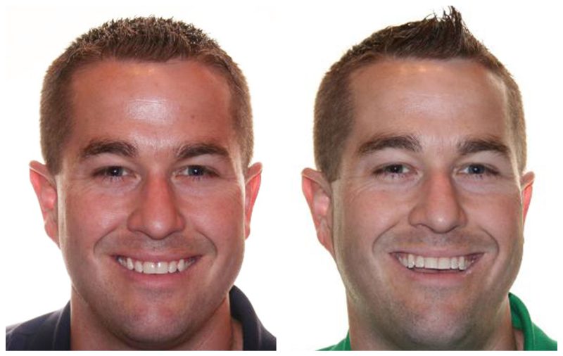 invisalign before and after male