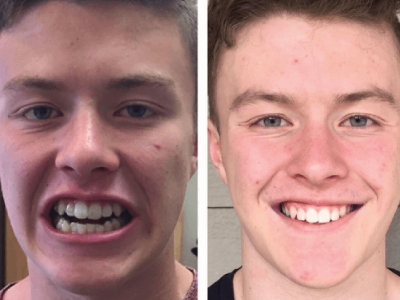 Invisalign before and after Regal Heights Dental Toronto dentist